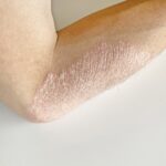 尋常性乾癬/掌蹠膿疱症について