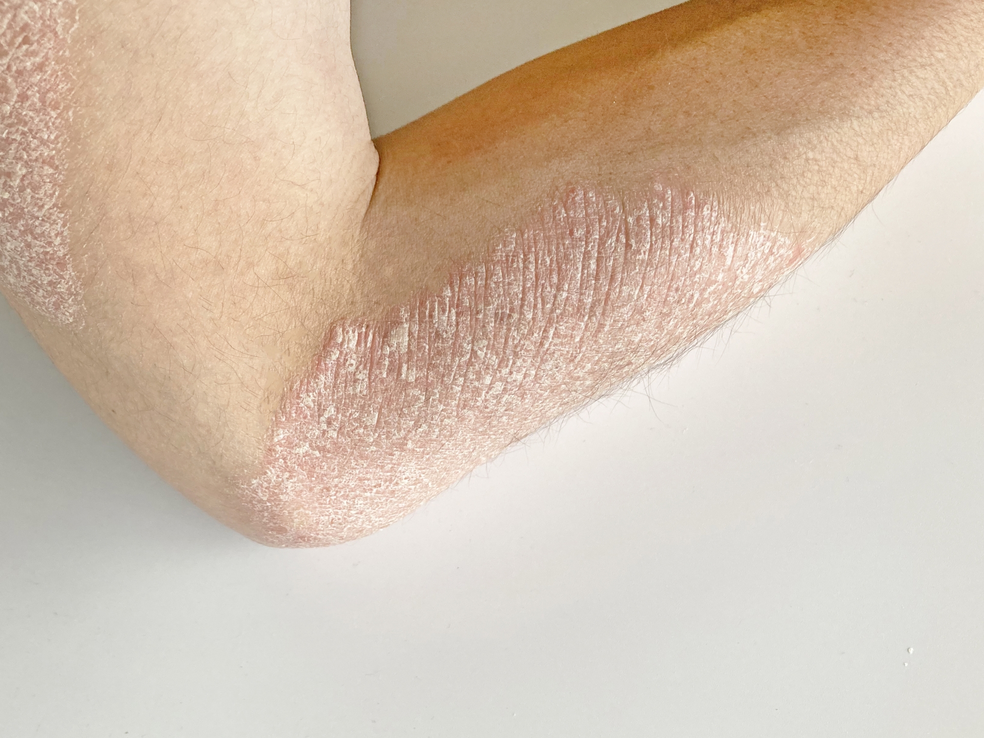 尋常性乾癬/掌蹠膿疱症について