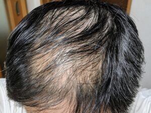脱毛症について
