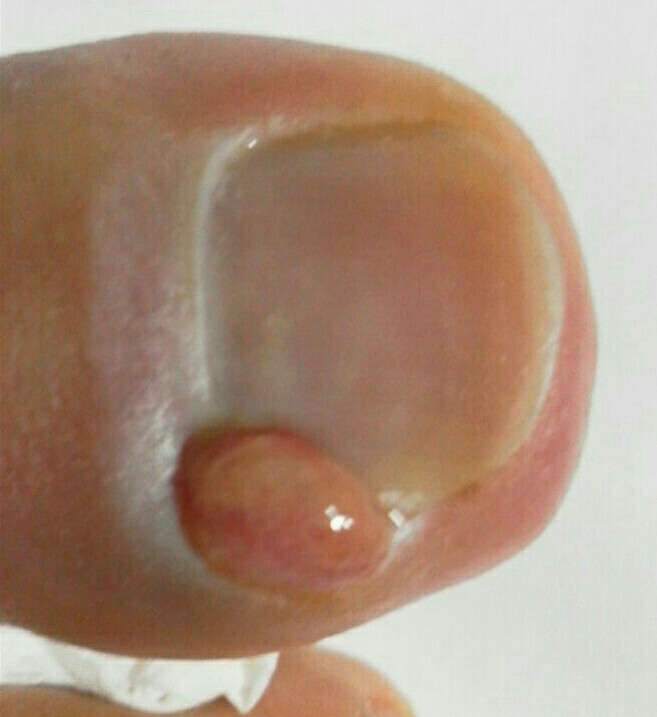 陥入爪
