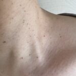 首いぼ（脂漏性角化症）