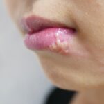 単純ヘルペスとは