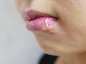 単純ヘルペスとは