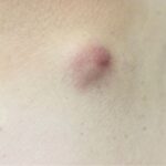 嚢胞性/慢性炎症性疾患