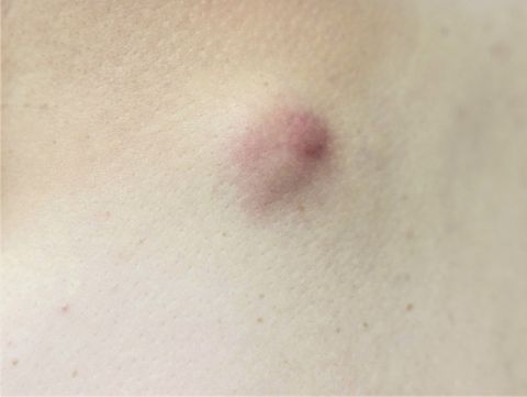 嚢胞性/慢性炎症性疾患